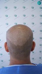 Injerto Capilar Técnica FUE Grafts 5326 (13645 Pelos) 24 25 DISENO DE LA LINEA DEL TRASPLANTE DE PELO