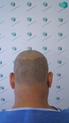Injerto Capilar Técnica FUE Grafts 5326 (13645 Pelos) 25 26 DISENO DE LA LINEA DEL TRASPLANTE DE PELO