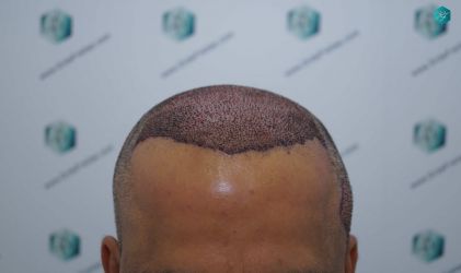 PRIMERA INTERVENCION TRASPLANTE DE PELO 27 TRASPLANTE DE PELO