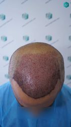 Injerto Capilar Técnica FUE Grafts 5326 (13645 Pelos) 26 28 TRASPLANTE DE PELO