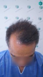 Injerto Capilar Técnica FUE Grafts 5326 (13645 Pelos) 2 3 ANTES DEL TRASPLANTE CAPILAR