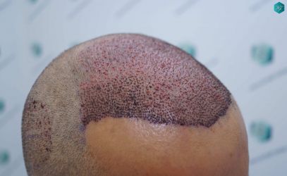 Injerto Capilar Técnica FUE Grafts 5326 (13645 Pelos) 27 30 TRASPLANTE DE PELO