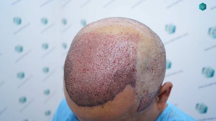 Injerto Capilar Técnica FUE Grafts 5326 (13645 Pelos) 28 31 TRASPLANTE DE PELO