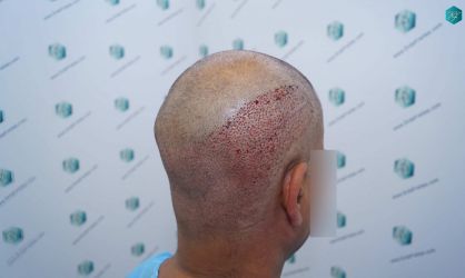 Injerto Capilar Técnica FUE Grafts 5326 (13645 Pelos) 29 35 TRASPLANTE DE PELO