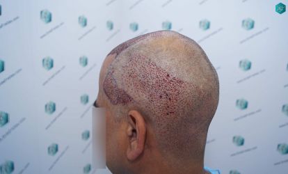 Injerto Capilar Técnica FUE Grafts 5326 (13645 Pelos) 30 36 TRASPLANTE DE PELO