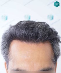 Injerto Capilar Técnica FUE Grafts 5326 (13645 Pelos) 31 37 RESULTADOS A LOS 12 MESES