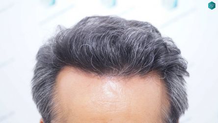 PRIMERA INTERVENCION RESULTADOS A LOS 12 MESES 38 RESULTADOS A LOS 12 MESES