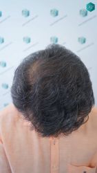Injerto Capilar Técnica FUE Grafts 5326 (13645 Pelos) 32 39 RESULTADOS A LOS 12 MESES