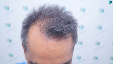 Injerto Capilar Técnica FUE Grafts 5326 (13645 Pelos) 3 4 ANTES DEL TRASPLANTE CAPILAR
