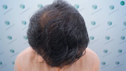 Injerto Capilar Técnica FUE Grafts 5326 (13645 Pelos) 33 40 RESULTADOS A LOS 12 MESES