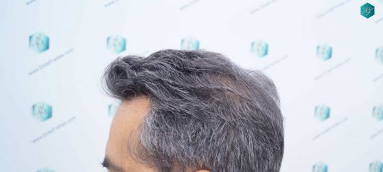 Injerto Capilar Técnica FUE Grafts 5326 (13645 Pelos) 34 41 RESULTADOS A LOS 12 MESES