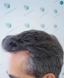 Injerto Capilar Técnica FUE Grafts 5326 (13645 Pelos) 35 42 RESULTADOS A LOS 12 MESES