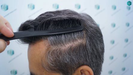 Injerto Capilar Técnica FUE Grafts 5326 (13645 Pelos) 36 43 RESULTADOS A LOS 12 MESES