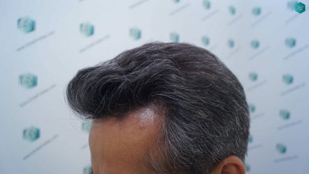 Injerto Capilar Técnica FUE Grafts 5326 (13645 Pelos) 37 44 RESULTADOS A LOS 12 MESES