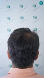 Injerto Capilar Técnica FUE Grafts 5326 (13645 Pelos) 38 45 RESULTADOS A LOS 12 MESES
