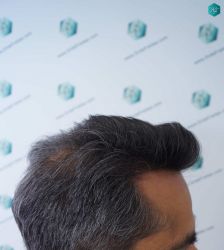 Injerto Capilar Técnica FUE Grafts 5326 (13645 Pelos) 39 47 RESULTADOS A LOS 12 MESES