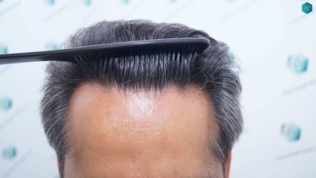 Injerto Capilar Técnica FUE Grafts 5326 (13645 Pelos) 40 47A RESULTADOS A LOS 12 MESES