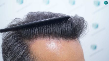 Injerto Capilar Técnica FUE Grafts 5326 (13645 Pelos) 41 48 RESULTADOS A LOS 12 MESES