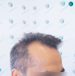 Injerto Capilar Técnica FUE Grafts 5326 (13645 Pelos) 4 5 ANTES DEL TRASPLANTE CAPILAR