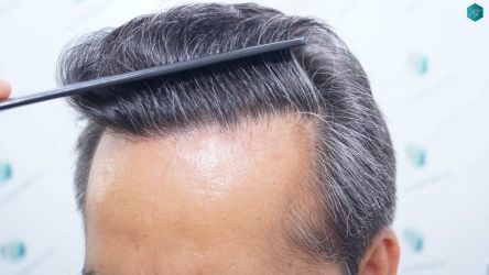 Injerto Capilar Técnica FUE Grafts 5326 (13645 Pelos) 42 50 RESULTADOS A LOS 12 MESES