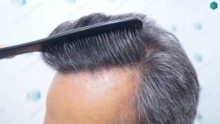 Injerto Capilar Técnica FUE Grafts 5326 (13645 Pelos) 43 51 RESULTADOS A LOS 12 MESES