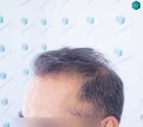Injerto Capilar Técnica FUE Grafts 5326 (13645 Pelos) 5 6 ANTES DEL TRASPLANTE CAPILAR
