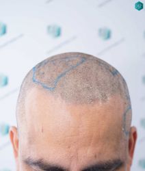 Injerto Capilar Técnica FUE Grafts 5326 (13645 Pelos) 45 60 SEGUNDA INTERVENCION DISENO