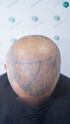 Injerto Capilar Técnica FUE Grafts 5326 (13645 Pelos) 46 61 SEGUNDA INTERVENCION DISENO