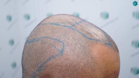 Injerto Capilar Técnica FUE Grafts 5326 (13645 Pelos) 47 62 SEGUNDA INTERVENCION DISENO