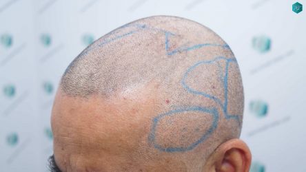 Injerto Capilar Técnica FUE Grafts 5326 (13645 Pelos) 48 63 SEGUNDA INTERVENCION DISENO