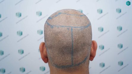 Injerto Capilar Técnica FUE Grafts 5326 (13645 Pelos) 50 65 SEGUNDA INTERVENCION DISENO