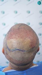 Injerto Capilar Técnica FUE Grafts 5326 (13645 Pelos) 51 66 SEGUNDA INTERVENCION TRASPLANTE CAPILAR