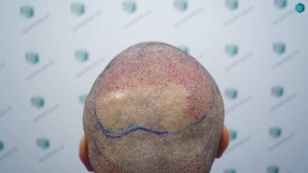 Injerto Capilar Técnica FUE Grafts 5326 (13645 Pelos) 52 67 SEGUNDA INTERVENCION TRASPLANTE CAPILAR