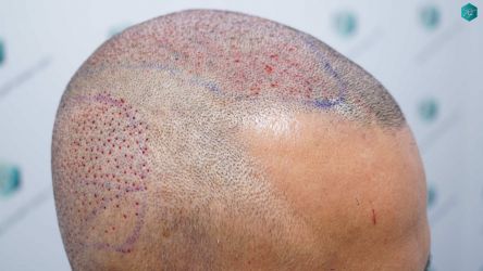 Injerto Capilar Técnica FUE Grafts 5326 (13645 Pelos) 53 68 SEGUNDA INTERVENCION TRASPLANTE CAPILAR