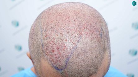 Injerto Capilar Técnica FUE Grafts 5326 (13645 Pelos) 54 69 SEGUNDA INTERVENCION TRASPLANTE CAPILAR