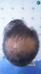 Injerto Capilar Técnica FUE Grafts 5326 (13645 Pelos) 18 7 ANTES DEL TRASPLANTE CAPILAR