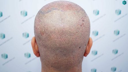 Injerto Capilar Técnica FUE Grafts 5326 (13645 Pelos) 56 71 SEGUNDA INTERVENCION TRASPLANTE CAPILAR