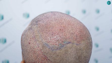 Injerto Capilar Técnica FUE Grafts 5326 (13645 Pelos) 59 74 SEGUNDA INTERVENCION TRASPLANTE CAPILAR