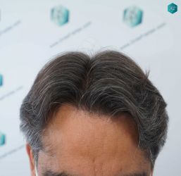 Injerto Capilar Técnica FUE Grafts 5326 (13645 Pelos) 61 76 RESULTADOS A LOS 12 MESES