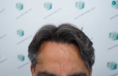 SEGUNDA INTERVENCION RESULTADOS A LOS 12 MESES 77 RESULTADOS A LOS 12 MESES