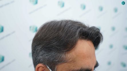Injerto Capilar Técnica FUE Grafts 5326 (13645 Pelos) 62 78 RESULTADOS A LOS 12 MESES