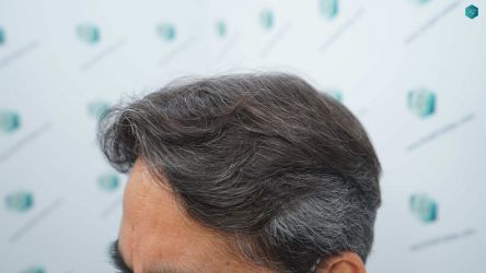 Injerto Capilar Técnica FUE Grafts 5326 (13645 Pelos) 63 79 RESULTADOS A LOS 12 MESES