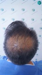 Injerto Capilar Técnica FUE Grafts 5326 (13645 Pelos) 17 8 ANTES DEL TRASPLANTE CAPILAR