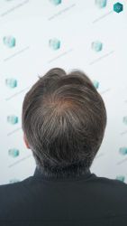 Injerto Capilar Técnica FUE Grafts 5326 (13645 Pelos) 64 80 RESULTADOS A LOS 12 MESES