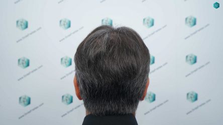 Injerto Capilar Técnica FUE Grafts 5326 (13645 Pelos) 65 80A RESULTADOS A LOS 12 MESES