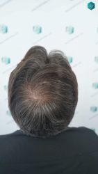 Injerto Capilar Técnica FUE Grafts 5326 (13645 Pelos) 66 81 RESULTADOS A LOS 12 MESES