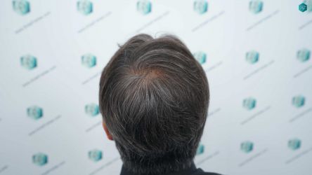 Injerto Capilar Técnica FUE Grafts 5326 (13645 Pelos) 67 81B RESULTADOS A LOS 12 MESES