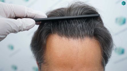 Injerto Capilar Técnica FUE Grafts 5326 (13645 Pelos) 68 82 RESULTADOS A LOS 12 MESES
