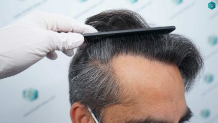 Injerto Capilar Técnica FUE Grafts 5326 (13645 Pelos) 69 83 RESULTADOS A LOS 12 MESES