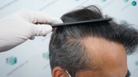 Injerto Capilar Técnica FUE Grafts 5326 (13645 Pelos) 70 83A RESULTADOS A LOS 12 MESES